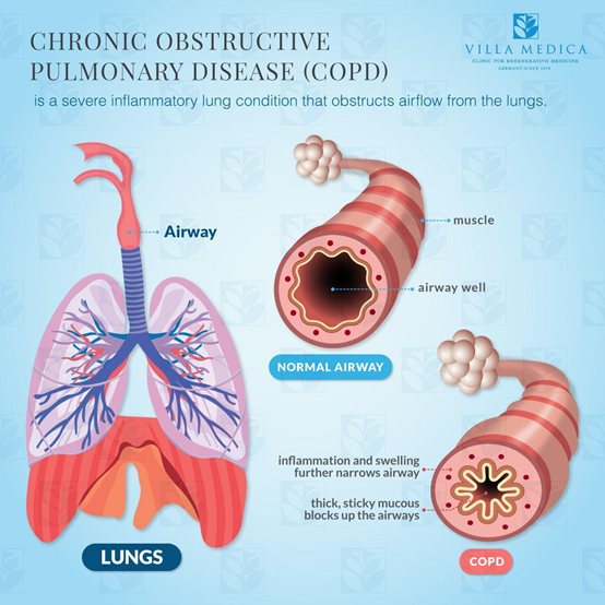 types-of-lung-diseases-and-causes-health-sutra-youtube